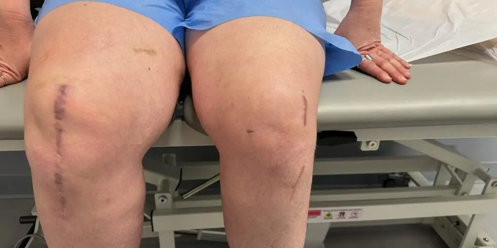 Knee Surgery Scars and Minimally Invasive Surgery