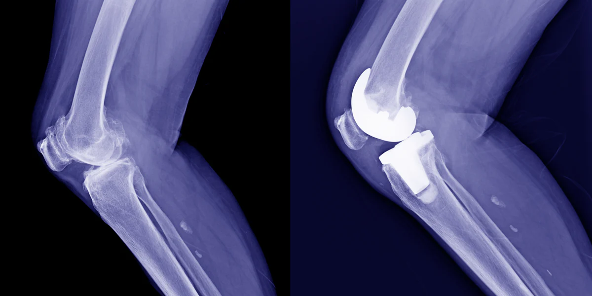 Side-by-side lateral knee X-rays: an arthritic knee before surgery and the same knee after a total knee replacement, with the implant visible