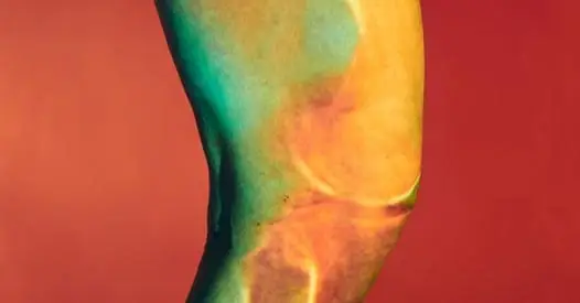 The Bridge-Enhanced ACL Restoration Implant-known as the BEAR implant