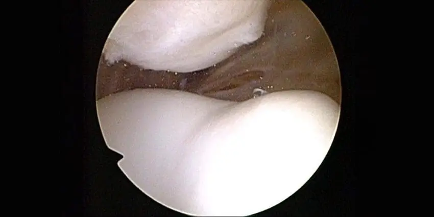 It's the Patellofemoral Height - Dr. Sabrina Strickland