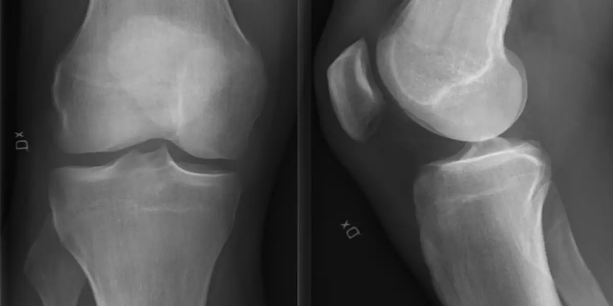 AI Chatbot Model Generating Reports on ACL Tears