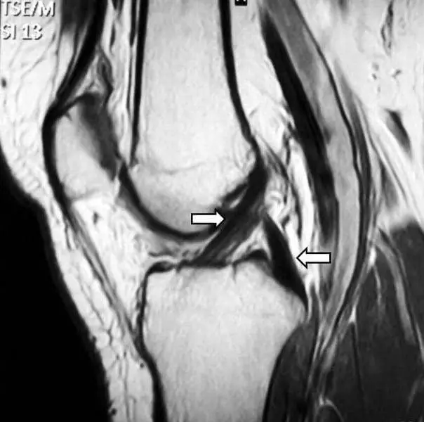 Anterior Knee Pain Following Hamstring ACL Reconstruction