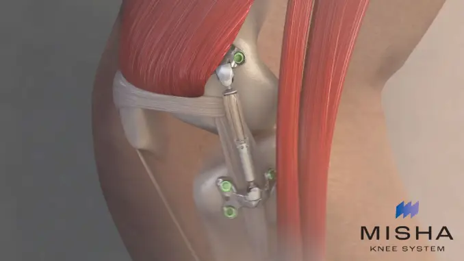 Moximed's MISHA™ Knee System Treats First Commercial Patients in United States
