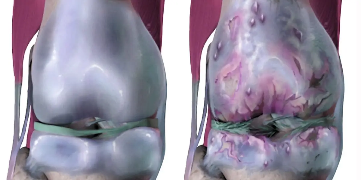 New Study Shows Osteoarthritis May Be Treatable and Reversible