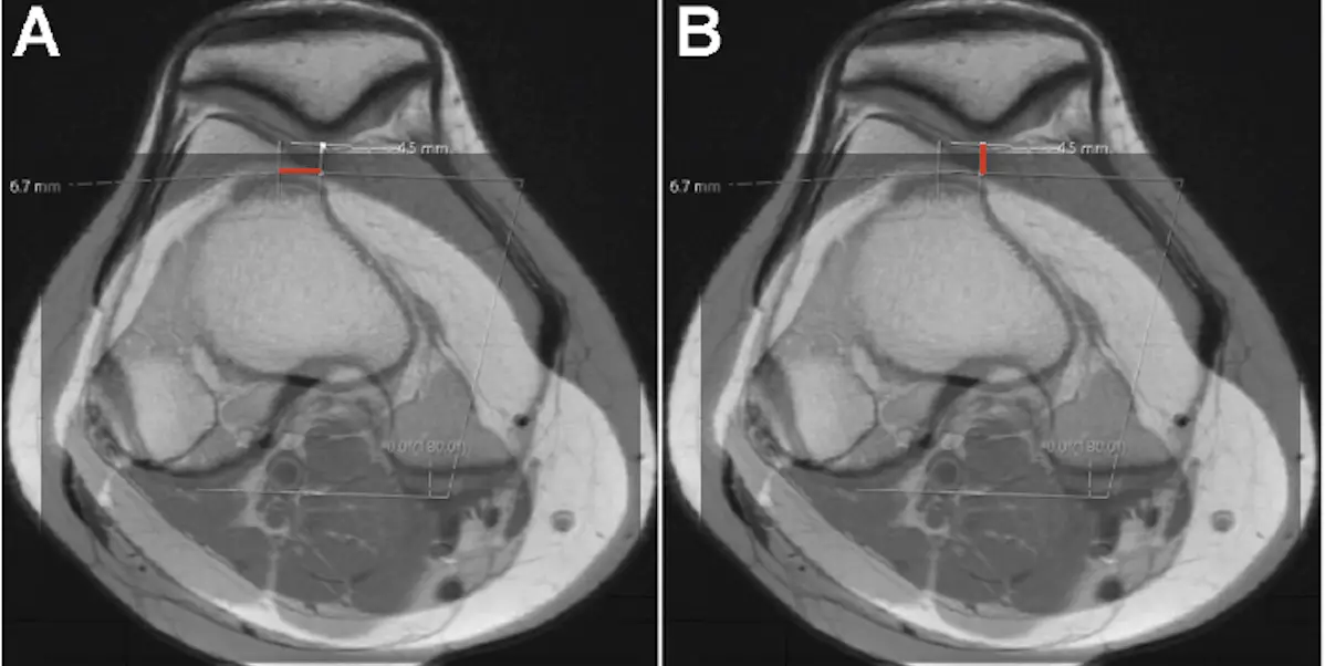 Exploring Risk Factors for Atraumatic Medial Patellar Facet Lesions