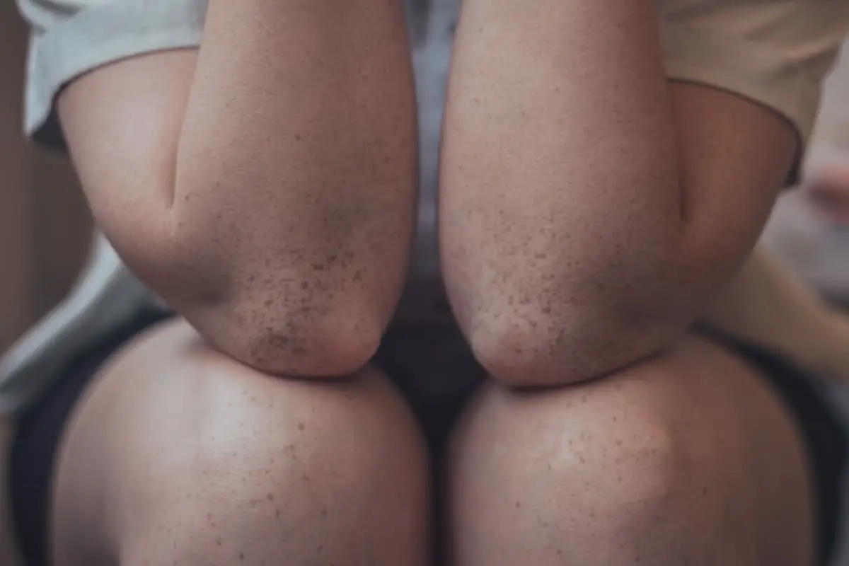 Treating Patellofemoral Arthritis &amp; Patellar Instability