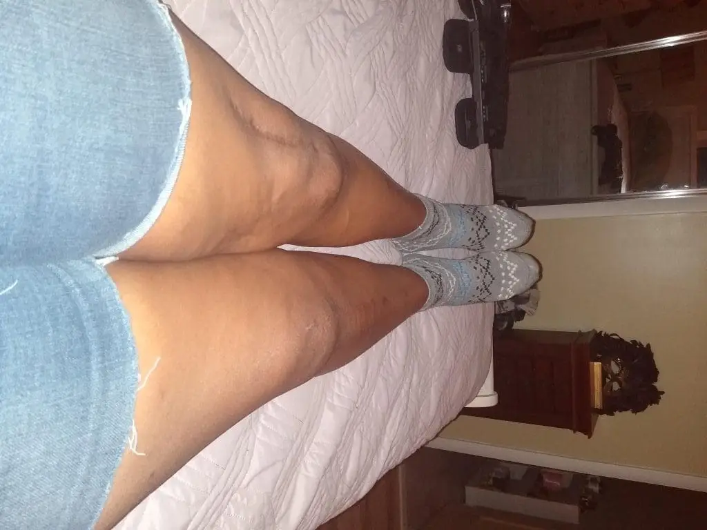 Knock Knee Surgery - And Valerie Bridges is Back in the Game