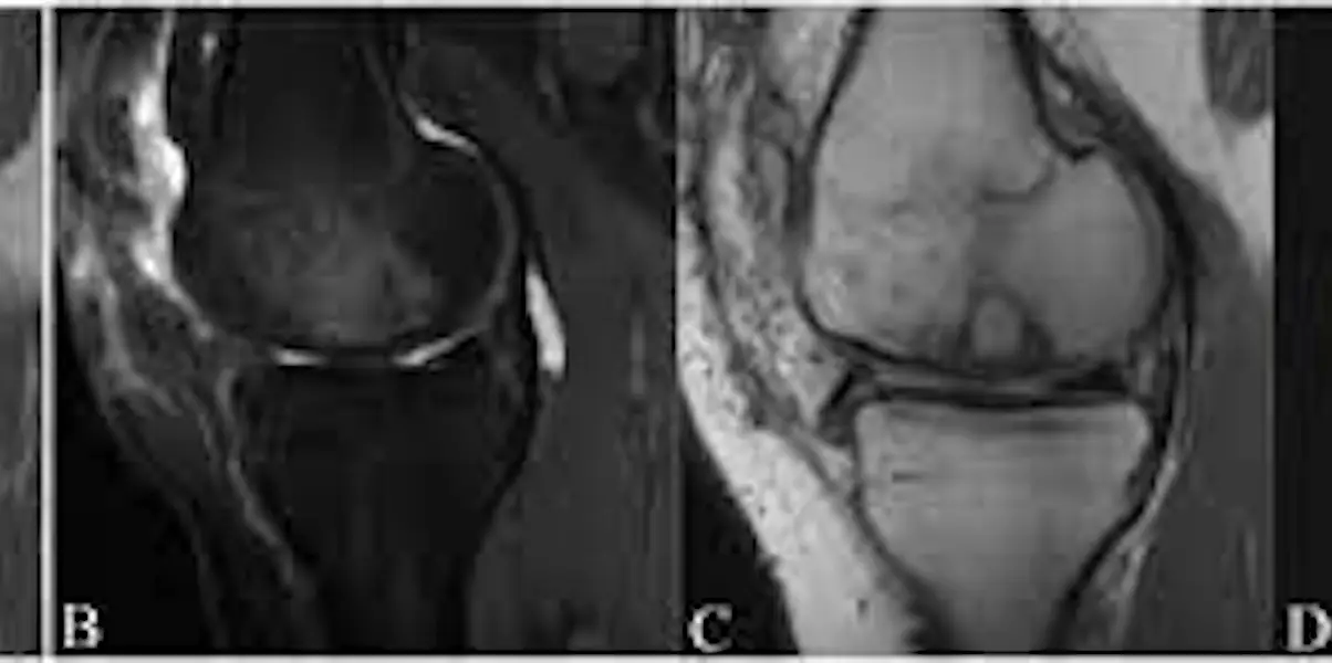 Risk Factor for Osteochondral Allograft Failure