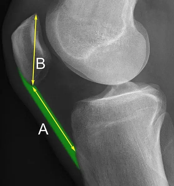 Surgical Treatment of Iatrogenic Patella Baja