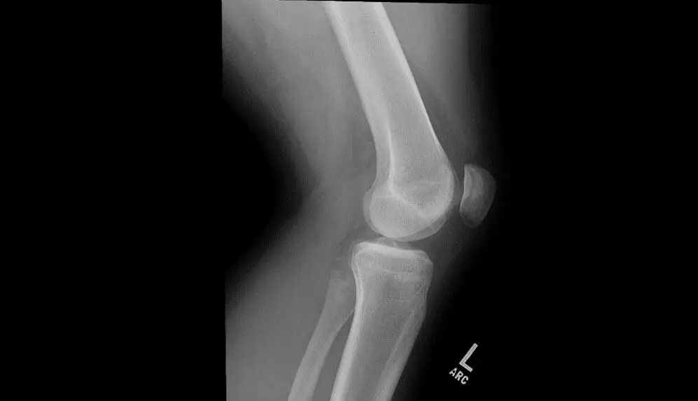 Two Fixation Points Are Better for MPFL Reconstruction