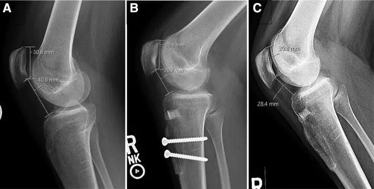 Lateral radiographs of the right knee from a 19-year-old female patient with patella alta and patellar instability who was indicated for tibial tubercle osteotomy with distalization.