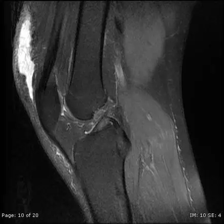 Anterior knee pain | Radiology Reference Article | Radiopaedia.org Anterior knee pain