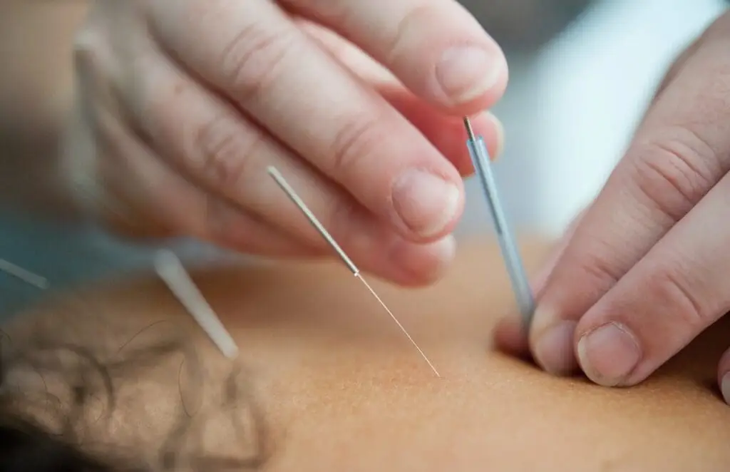 A Qualitative Analysis of Intraoperative Acupuncture for Nosocomephobia: The Unseen Patient.