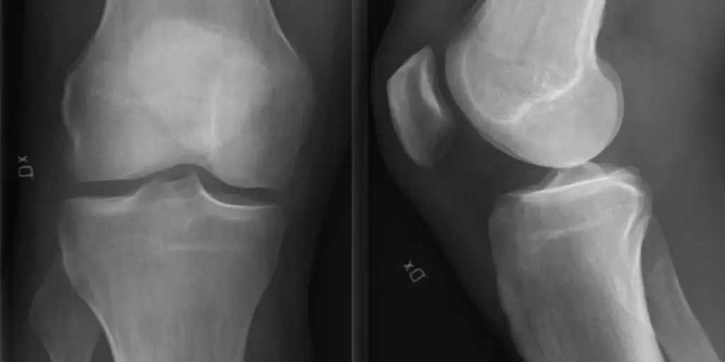 AI Chatbot Reads Knee X-Rays for ACL Repair Diagnosis