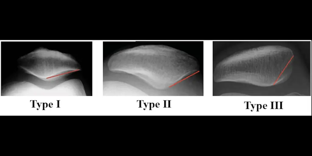 Impact of Wiberg Patellar Type on Outcomes and Survival Following Cell-Based Cartilage Repair for Patellar Chondral Lesions at Midterm Follow-up