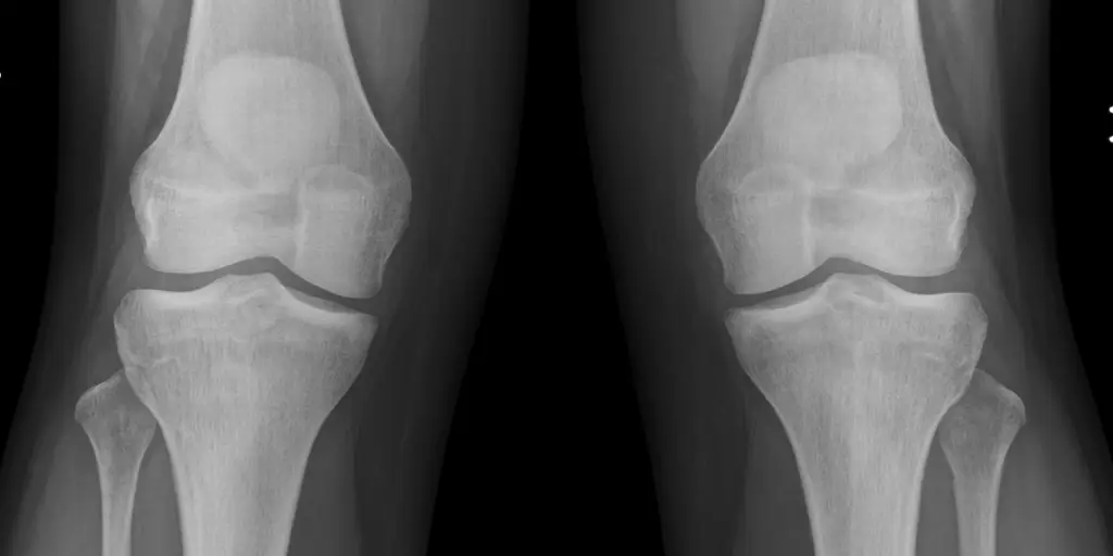 PatellaAlta XRay B