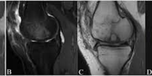 Increased Host Bone Marrow Edema on 6-Month MRI Is a Risk Factor for Osteochondral Allograft Failure
