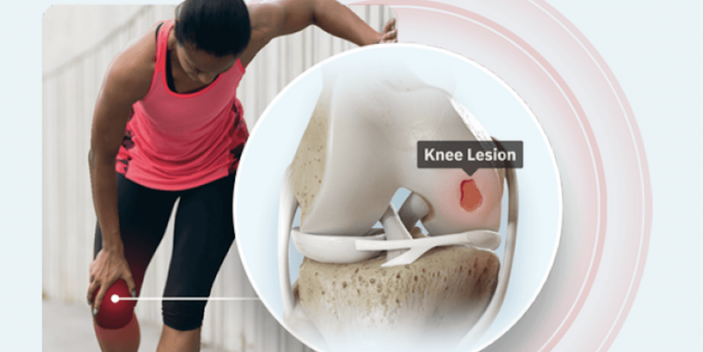 FDA Trial: HYALEX® Knee Cartilage System