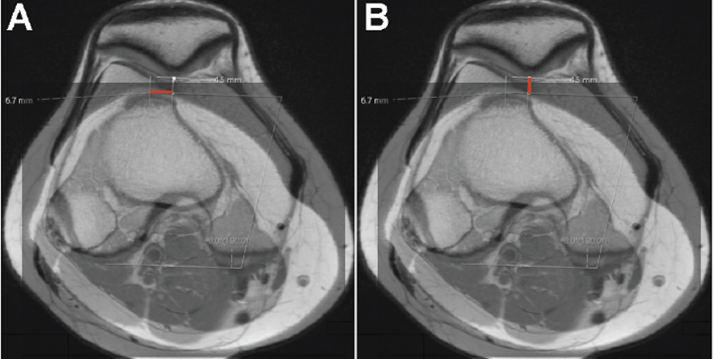 Risk Factors for Atraumatic Medial Patellar Facet Lesions