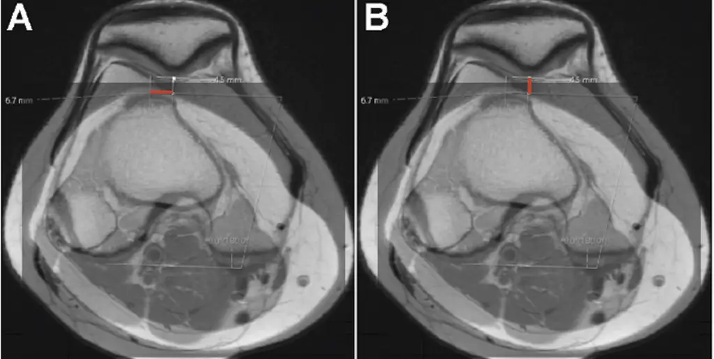 Risk Factors for Atraumatic Medial Patellar Facet Lesions