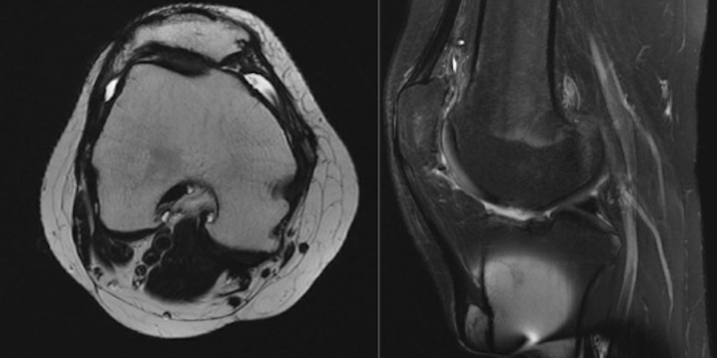 We have followed our patients who have undergone MACI cartilage transplantation after surgery both in the office as well as by getting MRI imaging.