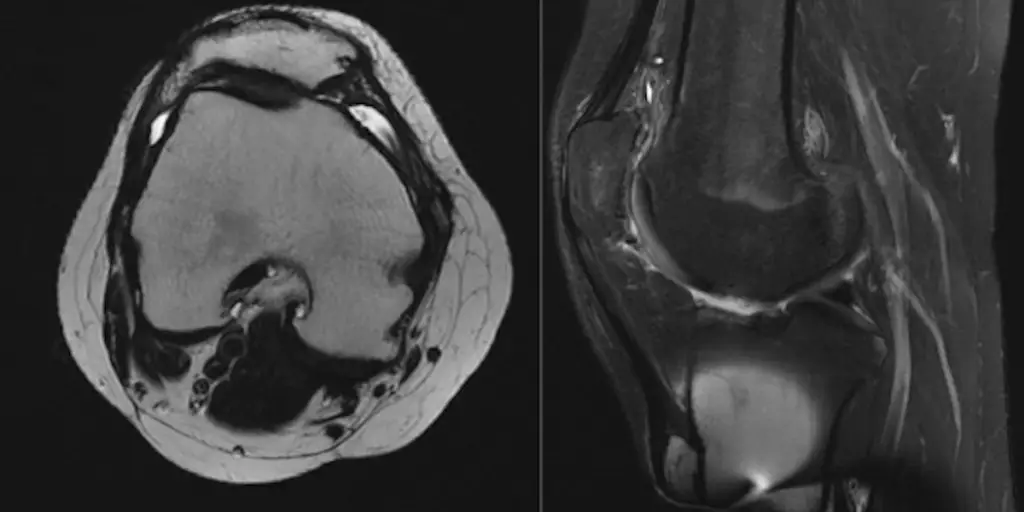 We have followed our patients who have undergone MACI cartilage transplantation after surgery both in the office as well as by getting MRI imaging.