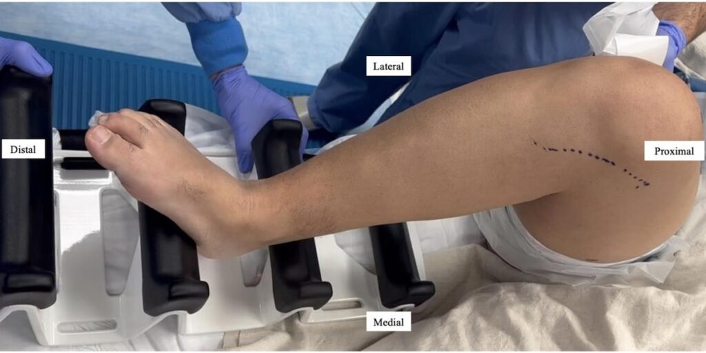 Medial Meniscus Root Repair With Implantable Shock Absorber Placement