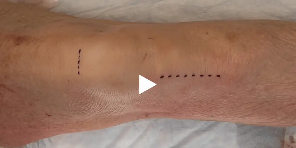 Staple Fixation for Combined ACWO, ACLR | Dr. Sabrina Strickland