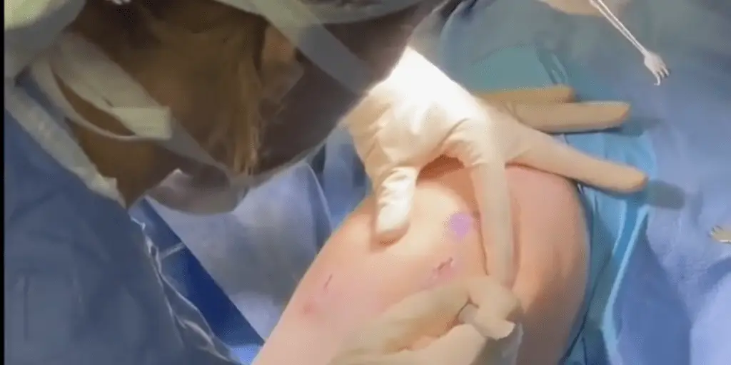 Treating Patellar Chondral Lesions with Concomitant MACI, MPFL, and TTO