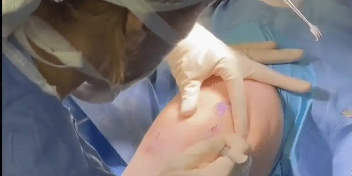 Treating Patellar Chondral Lesions with Concomitant MACI, MPFL, and TTO