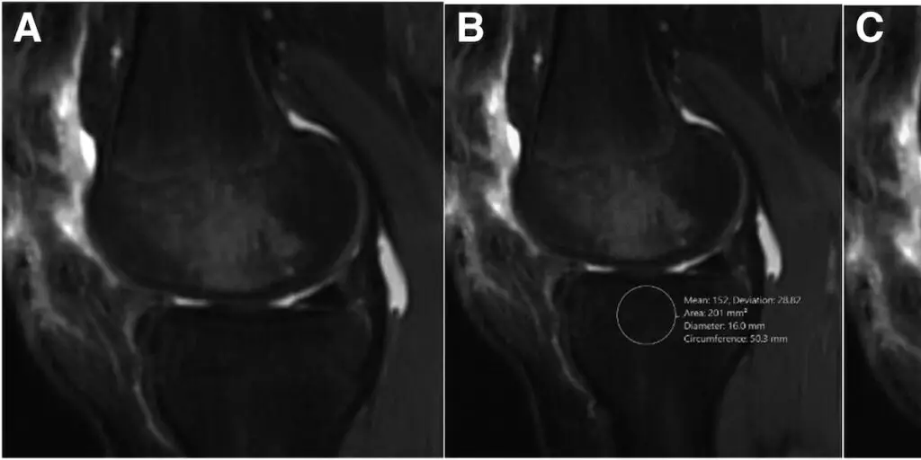 Increased Host Bone Marrow Edema on 6-Month Magnetic Resonance Imaging Is a Risk Factor for Osteochondral Allograft Failure