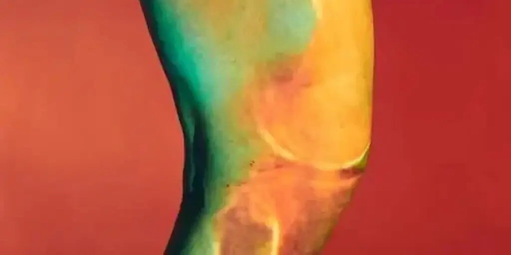 bridge enhanced ACL restoration technique or BEAR technique