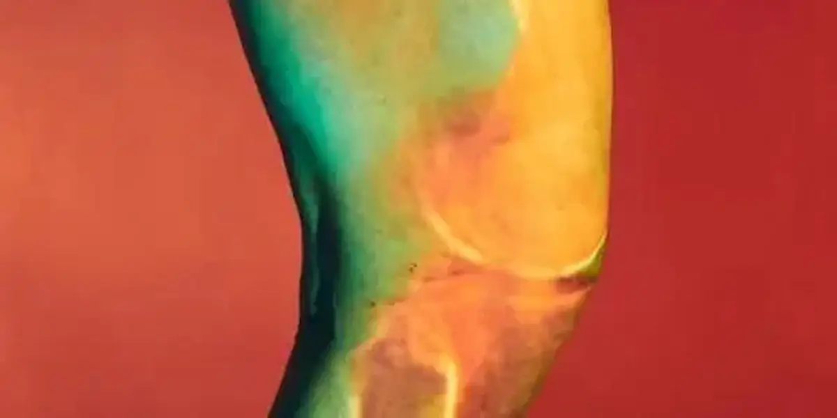 bridge enhanced ACL restoration technique or BEAR technique