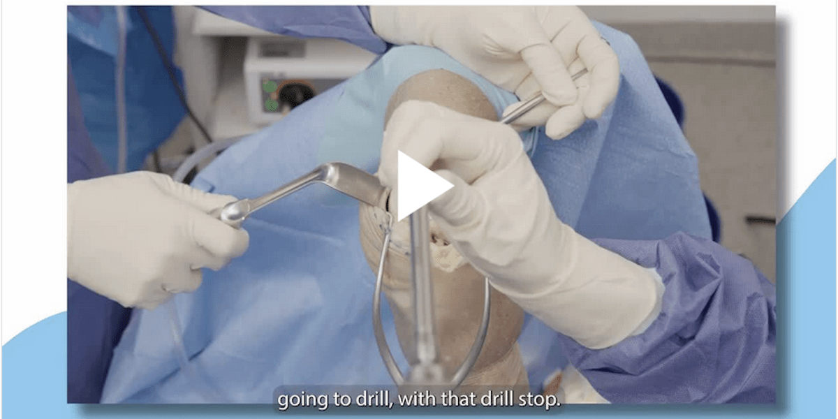 Dr. Sabrina Strickland discusses using CARTIHEAL AGILI-C to treat trochlea lesions.