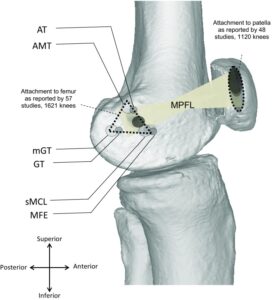 MPFL Reconstruction Surgery