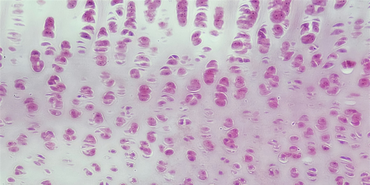 New Stanford Research Hints at the Future of Knee Arthritis Treatment